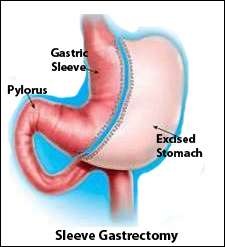 Diagram showing the sleeve gastrectomy procedure and removal of a portion of the stomach.