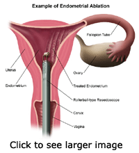 endometrial ablation