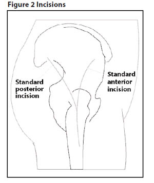 Diagram showing the incision line for a total hip replacement
