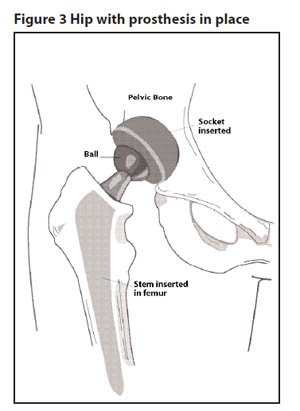 Diagram of the hip following joint replacement