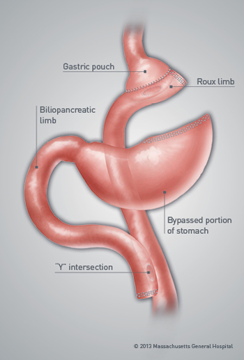 Diagram showing creation of a small gastric pouch and stapling of the remainder of the stomach done during the gastric bypass procedure.