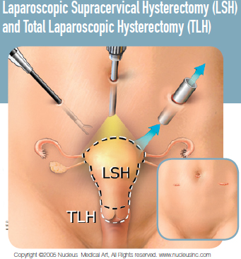 laparoscopic hysterectomy before and after