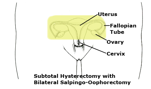 Ooforectomia bilateral.  Download Scientific Diagram